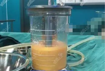 黑河360度水动力吸脂费用多少钱？