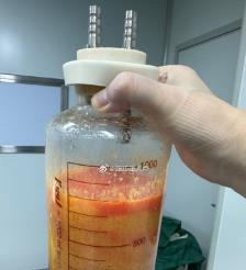 黑河水动力吸脂手术要做多久？